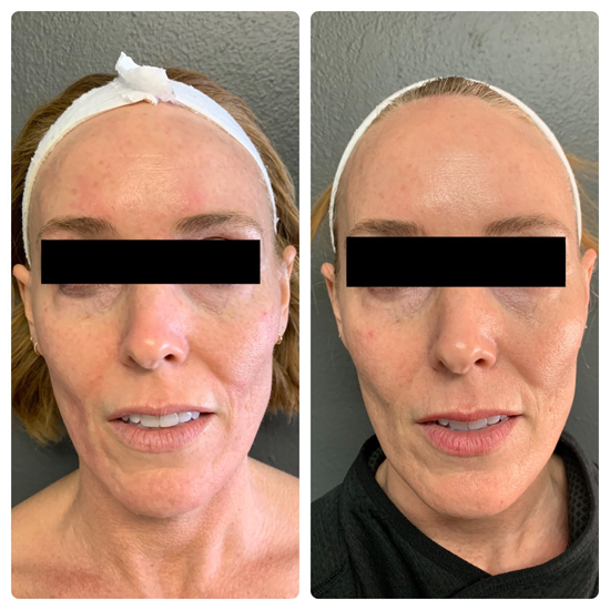 My CO2 Laser + Filler + Microneedling Update & Thoughts… : r/AcneScars