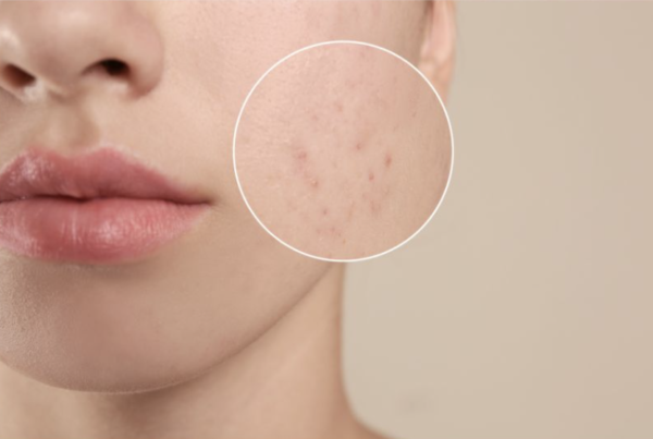 Picture of woman with acne and part of her face magnified so you can see it.