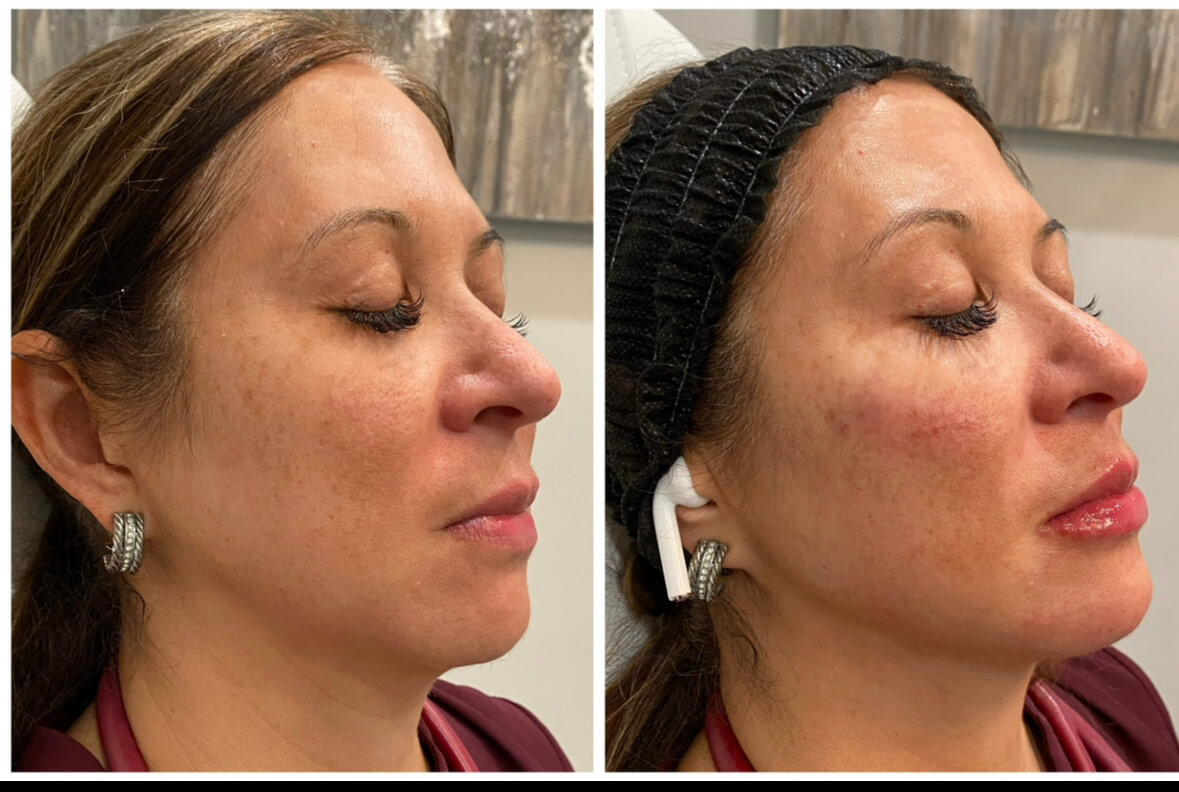 Cheeks and chin facial balancing