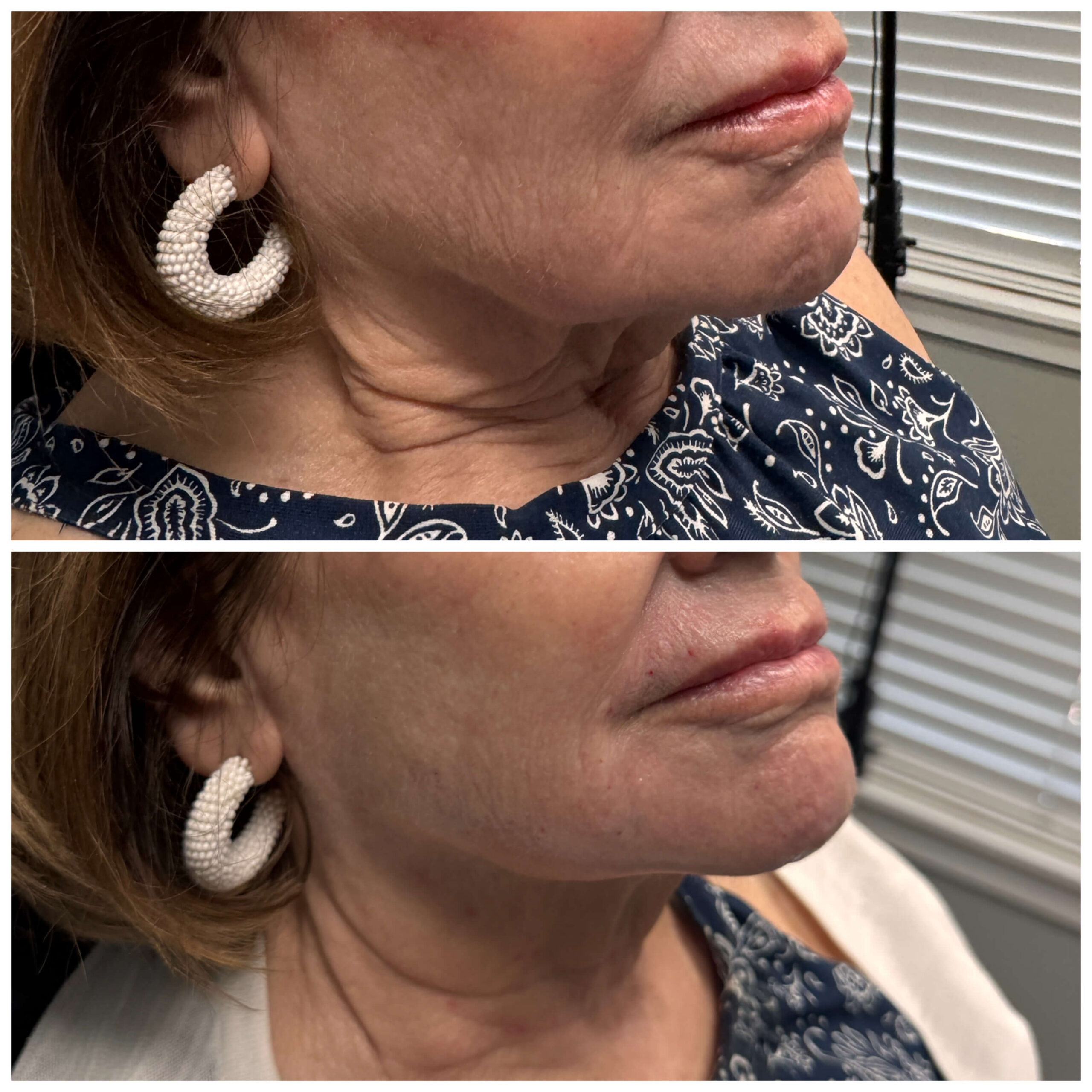 Jaw and Neck before and after
