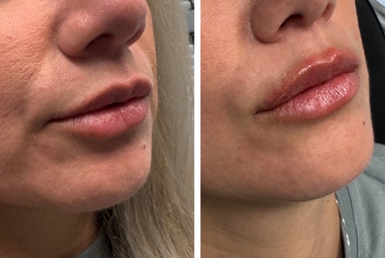 Lip filler before and after