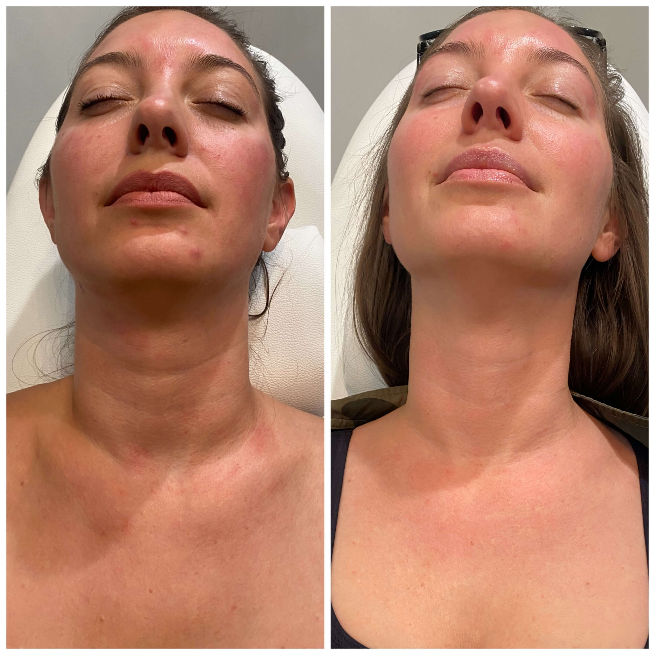 Tech Neck before and after