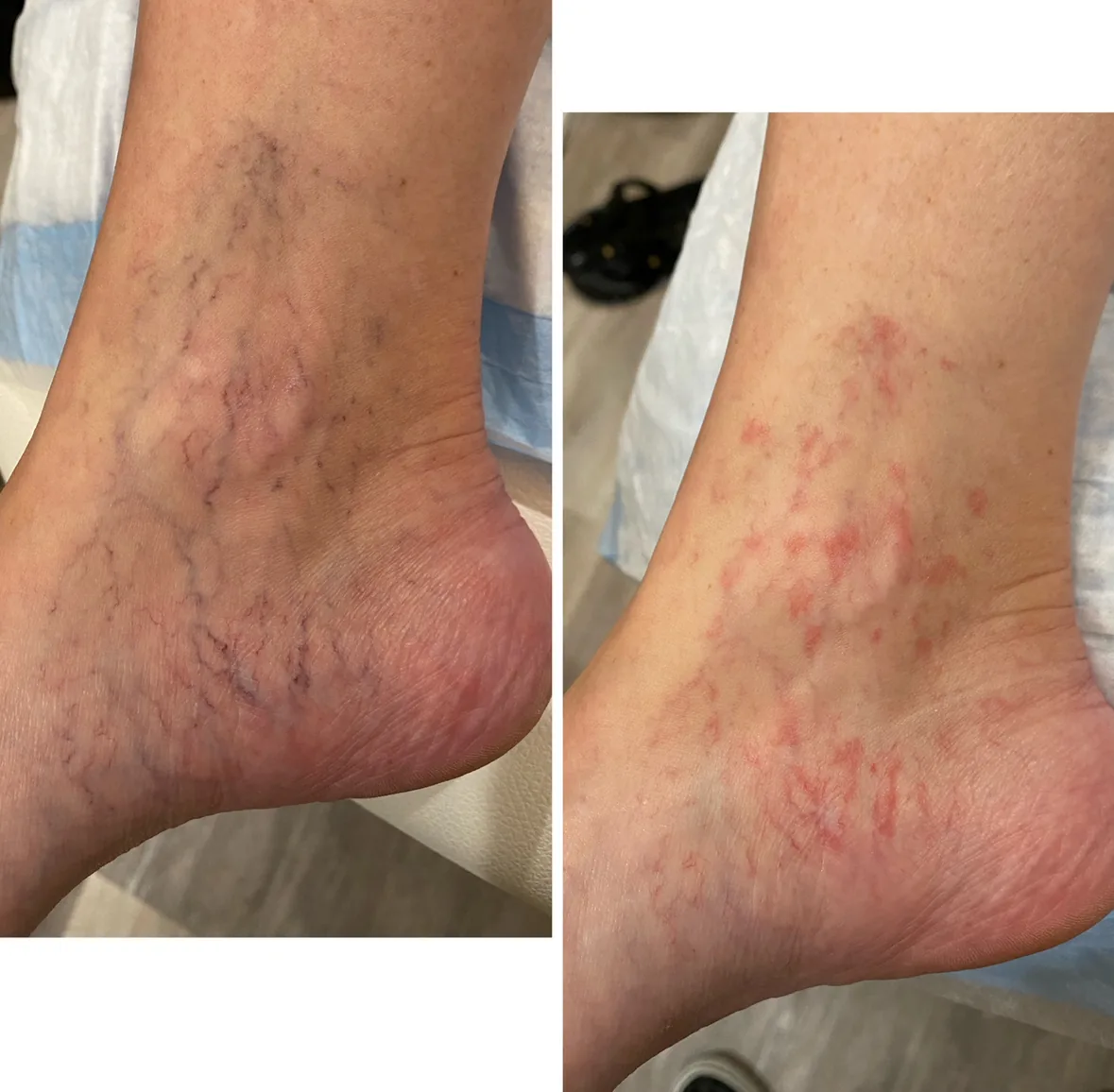 Ankle spider veins before GentleMax Pro laser treatment, and the typical red reaction immediately after