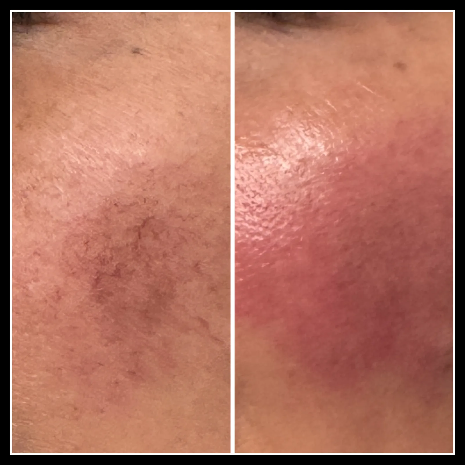 Cheek with facial spider veins before GentleMax Pro laser treatment, and with expected redness right after