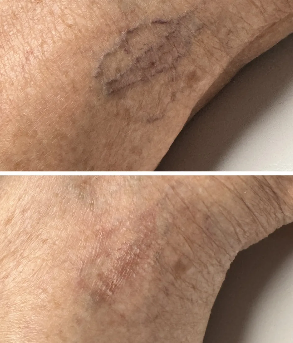 Before and after GentleMax Pro laser vein treatment on the leg, showing a faded cluster of purple spider veins