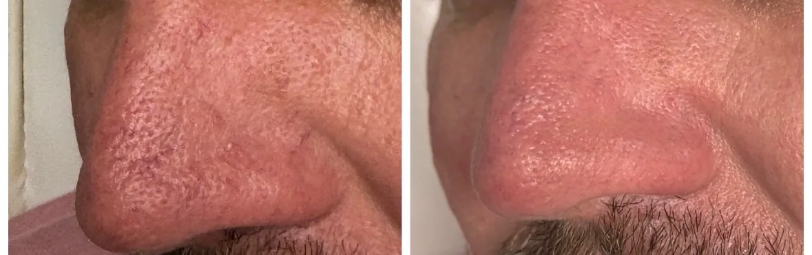Before and after GentleMax Pro laser vein treatment on a man's nose, showing reduced visible broken capillaries