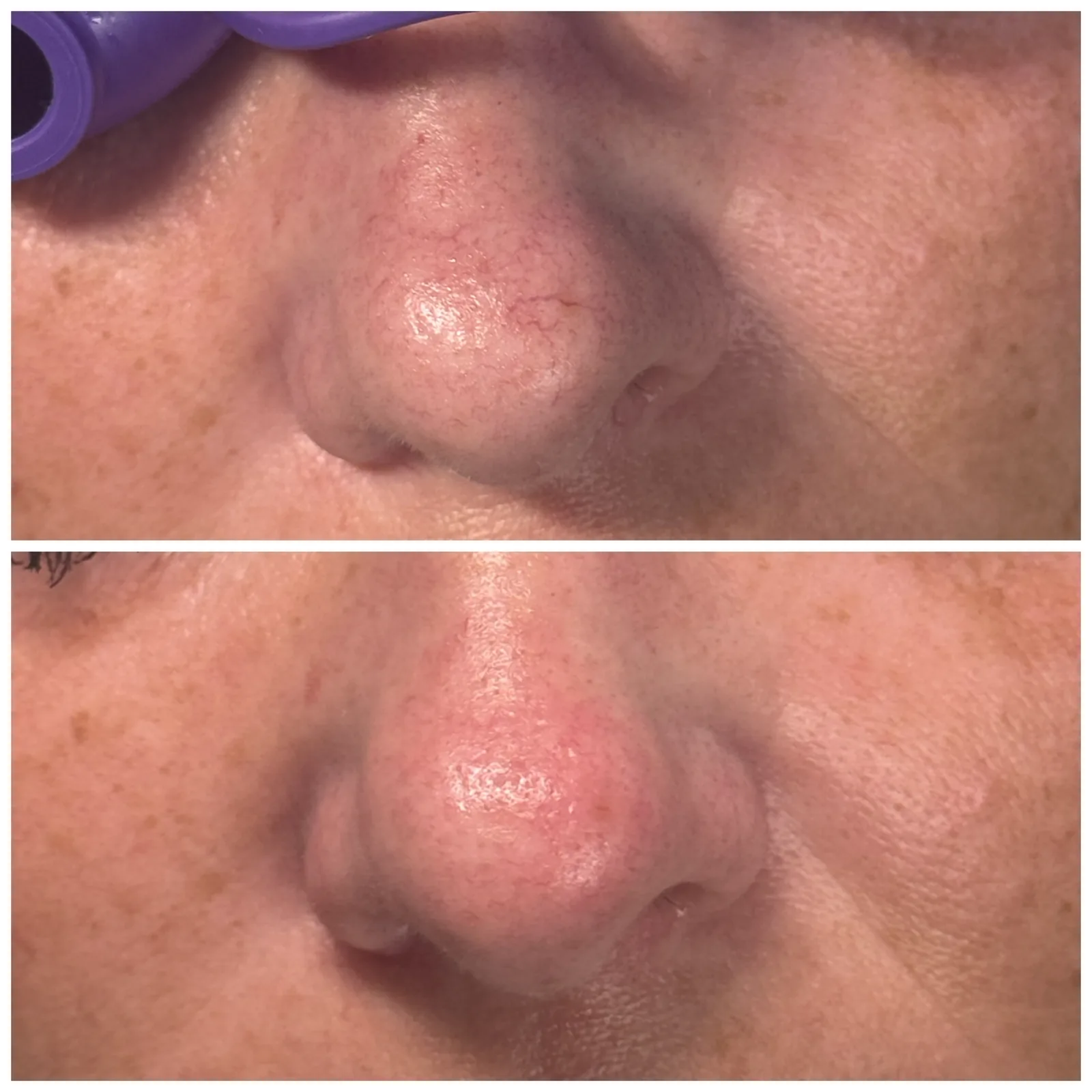 Before and after GentleMax Pro laser treatment of red spider veins on the nose, with visibly clearer skin after